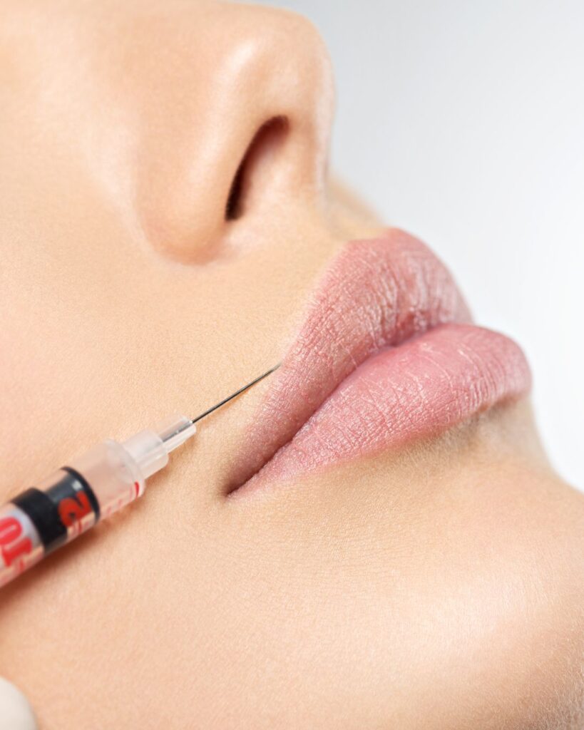 Hyaluronic acid gel integrating smoothly into lip tissue