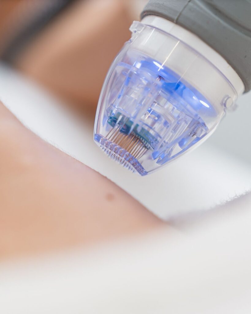 PRP Facial in Arlington Heights, IL